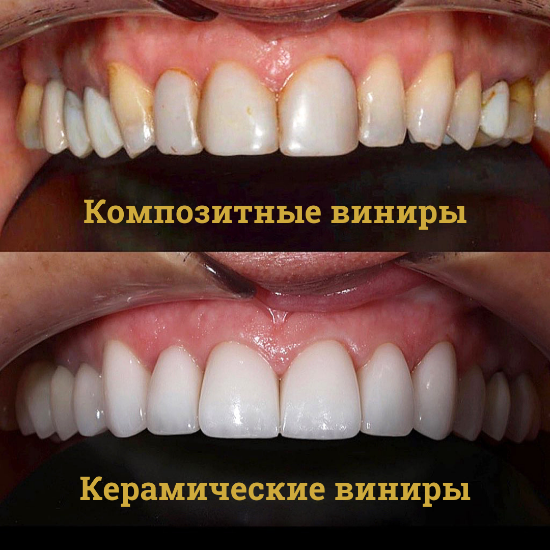 Композитные виниры Томск Гоголя недорогая и качественная стоматология в томске